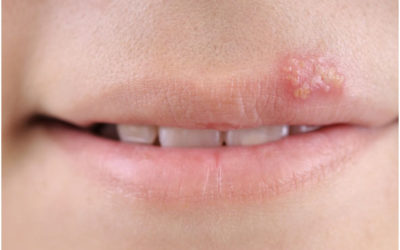 Micropigmentación y herpes labial